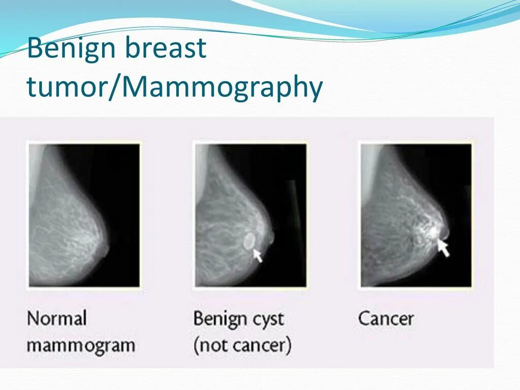 Рак соска молочной железы симптомы фото SON 2147 Sonography of the Breast - ppt download