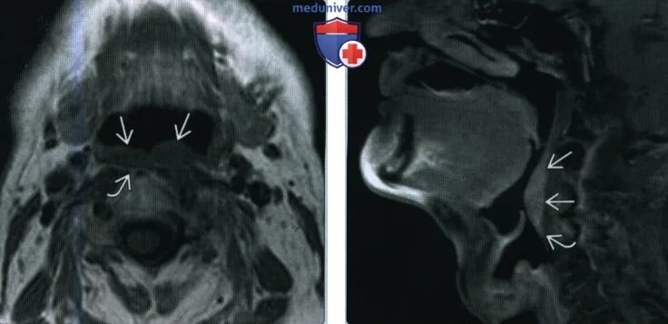 Рак стенки горла фото Плоскоклеточный рак задней стенки ротоглотки - лучевая диагностика
