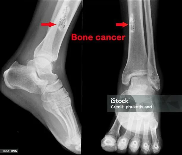 Рак стопы фото симптомы Кость Рак - стоковые фотографии и другие картинки Горизонтальный - Горизонтальны