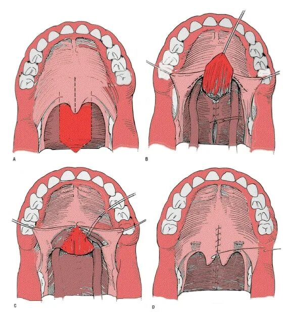 Рак твердого неба фото Рака неба во рту - Olphoto.ru