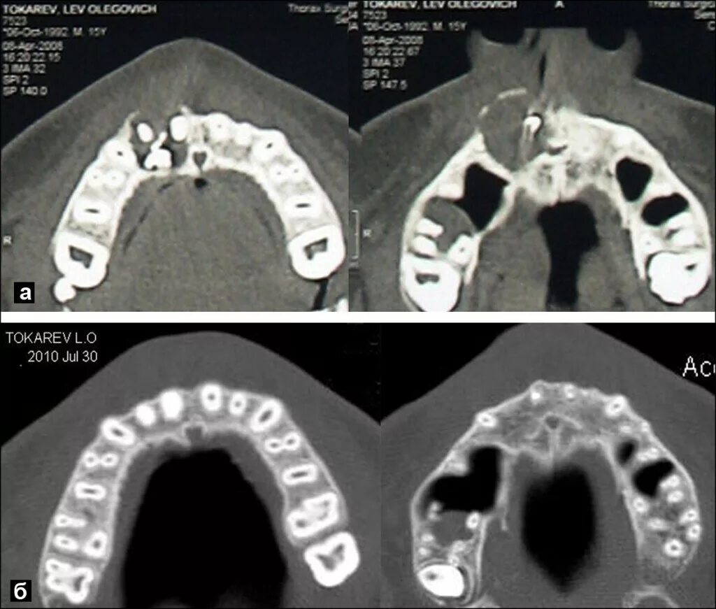 Рак твердого неба фото Neuralgia ilmeni hampaan( hampaiden) hoidon jälkeen