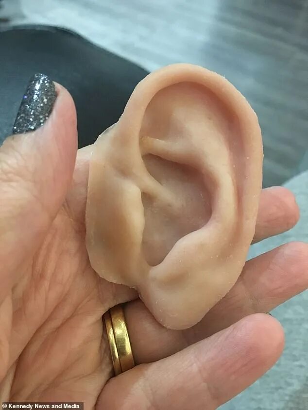 Рак уха фото Mother, 43, who was told her skin cancer was just a wart have has her ear AMPUTA