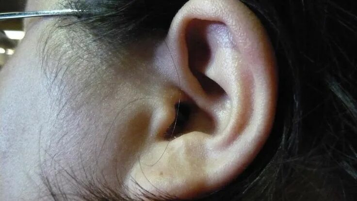 Рак уха фото наружного Tuning Out Tinnitus: New Study Indicates Possible New Therapy for This Condition