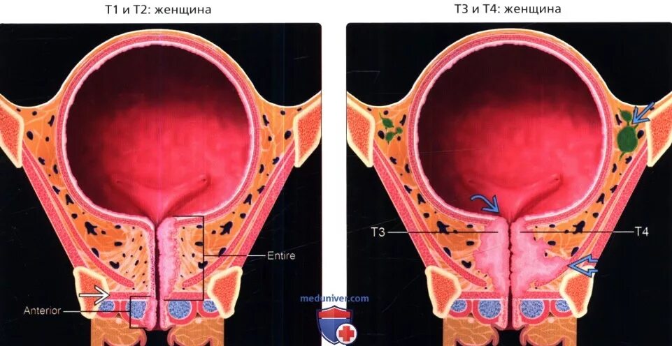 Рак уретры у женщин симптомы фото TNM стадии рака уретры