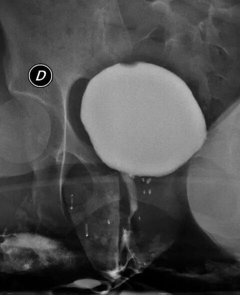 Рак уретры у женщин симптомы фото Female urethra - Centro di Chirurgia Ricostruttiva Genito-Uretrale