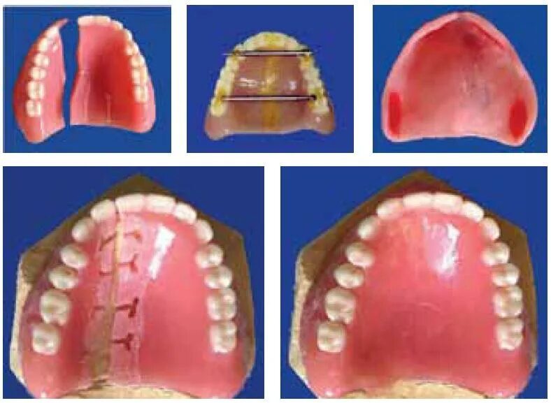 Рак верхнего неба фото Починка, коррекция, перебазировка съемного протеза полного зубного ряда (1077) -