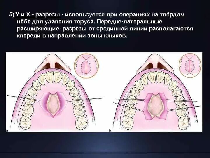 Рак верхнего неба фото и симптомы Воспаление твердого неба - Арт Минск.ру