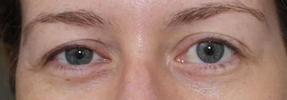 Eyelid Cancer - All About Vision