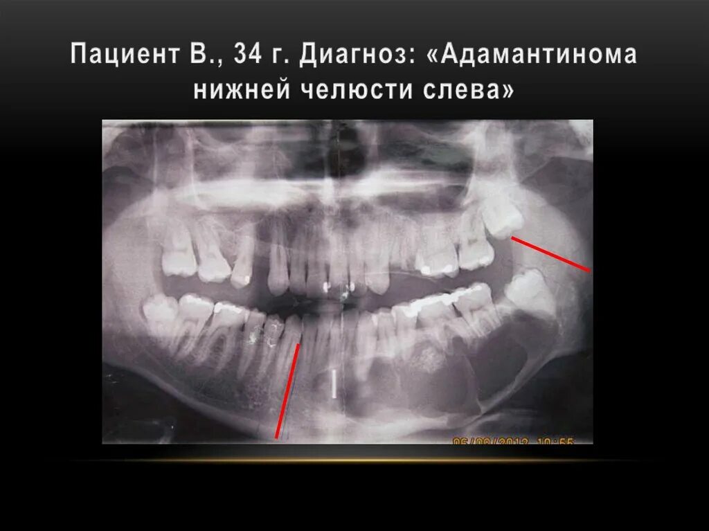 Рак верхней челюсти фото Особенности костнопластических операций при дефектах нижней челюсти - презентаци