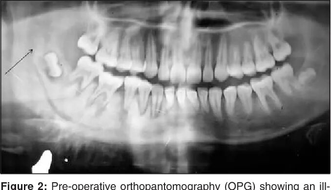 Рак верхней челюсти фото Figure 2 from Osteosarcoma of the mandible--second cancer in a case of Hodgkin's