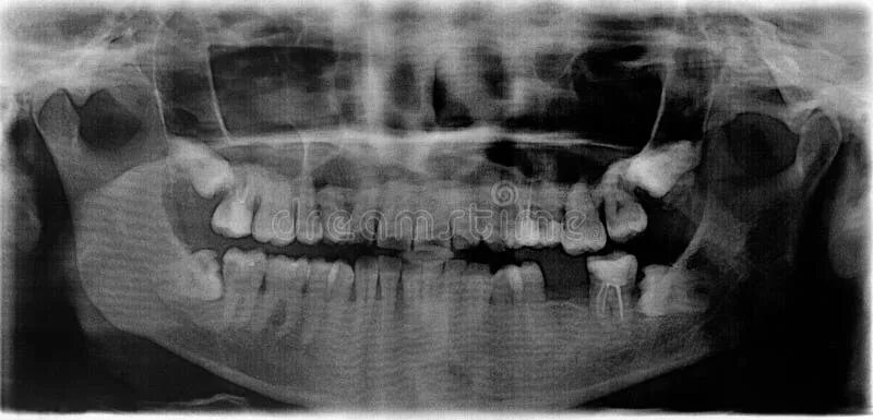 Рак верхней челюсти фото X Ray of a 50-year-old Woman`s Mouth in 360 Perspective Orthopantomogram Stock I