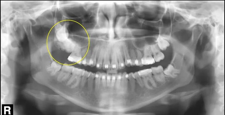 Рак верхней челюсти симптомы фото Odontoma e suas classificações atuais - XVII - Papaiz Diagnósticos Odontológicos