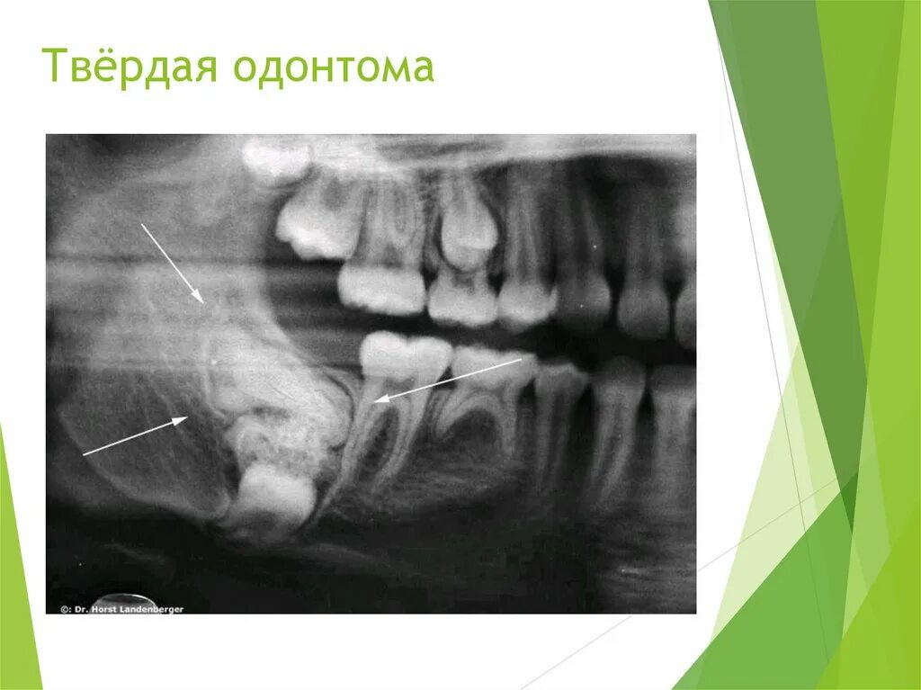 Рак верхней десны фото Одонтома, цементома. Амелоблатсома, амелобластическая и одонтогенная фибромы, ми