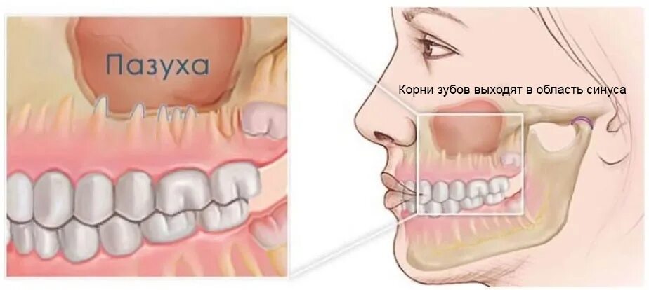 Рак верхней десны фото Имплантация верхних зубов Стоматология Dентал Мир