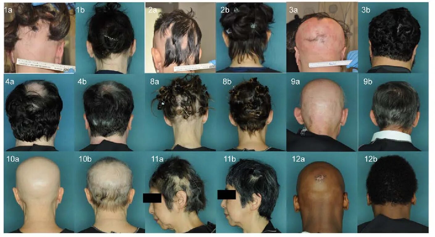 Рак волос фото Figure 2 from Oral ruxolitinib induces hair regrowth in patients with moderate-t