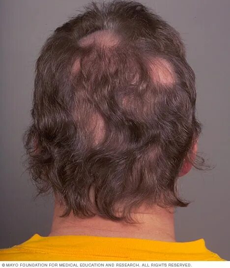 Рак волос фото Hair loss - Symptoms and causes - Mayo Clinic