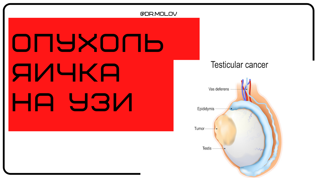 Рак яичек симптомы фото Опухоль яичка на УЗИ мошонки - Клиника Молова М.Р