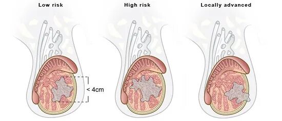 Рак яичек симптомы фото Testicular cancer treatment in Israel