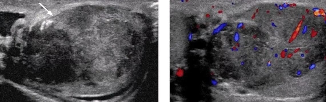 Рак яичек у мужчин симптомы фото Образования в яичках на УЗИ (лекция на Диагностере) - Диагностер