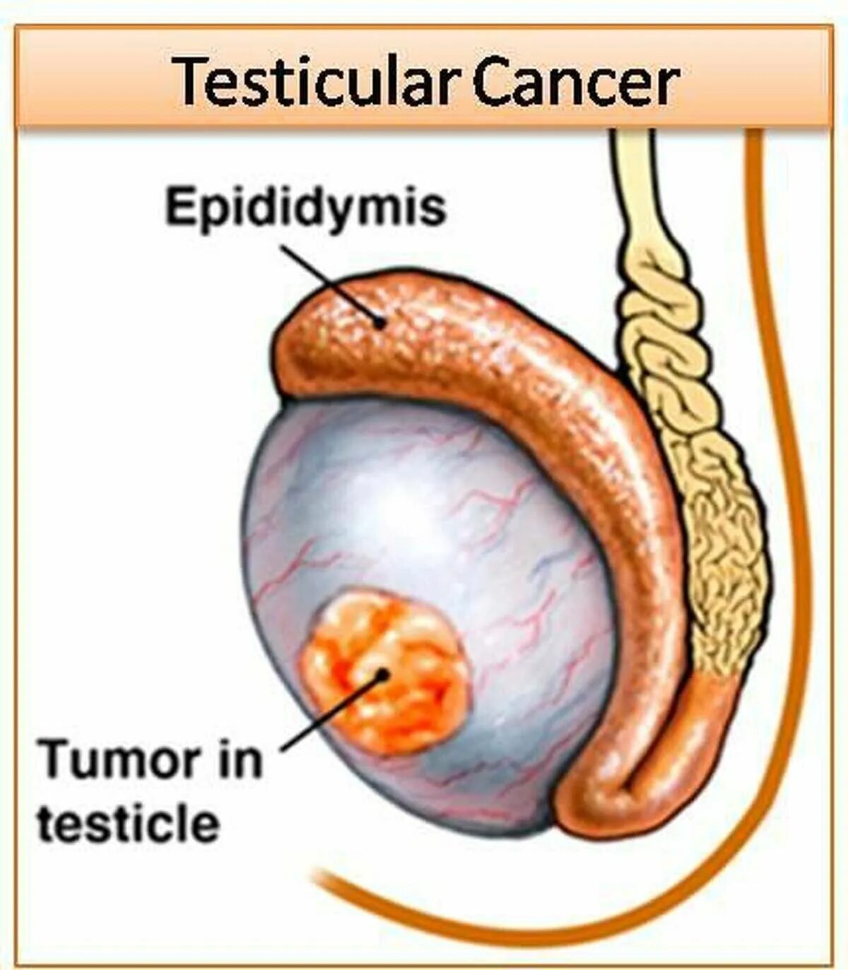 Рак яичек у мужчин симптомы фото What Are The Clinical Manifestations Of Testicular Cancer Quizlet