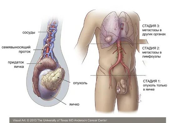 Рак яичек у мужчин симптомы фото Удаление яичка при раке - орхифуникулэктомия