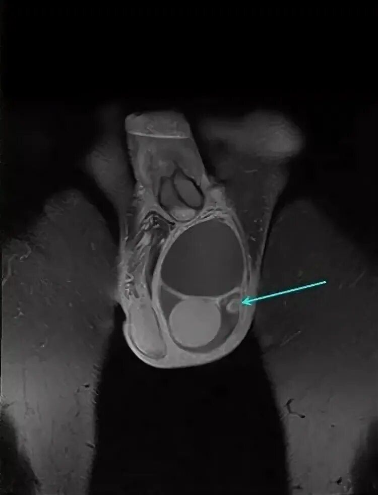 Рак яичек у мужчин симптомы фото МРТ мошонки и полового члена: органов, яичек у мужчин что показывает