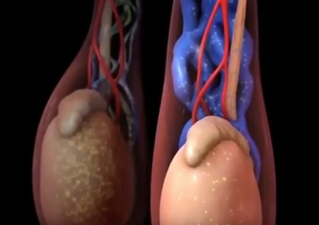 Рак яичек у мужчин симптомы фото Картинки ВАРИКОЦЕЛЕ ЯИЧЕК ЛЕЧЕНИЕ