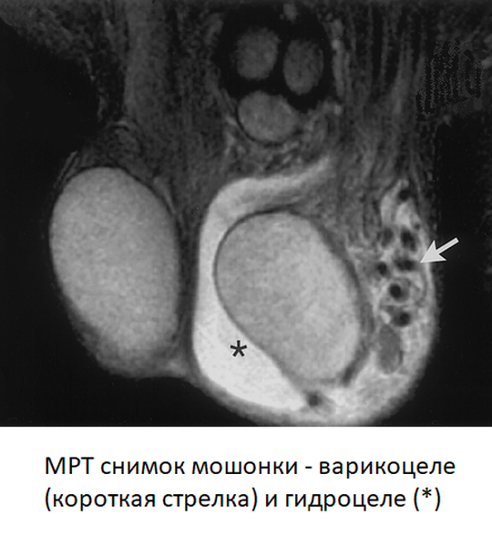 Рак яичка фото снаружи МРТ мошонки, что показывает - доброкачественные и злокачественные опухоли
