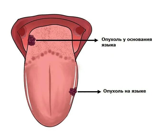 Рак языка 1 стадия фото Рак языке - Вопросы и ответы