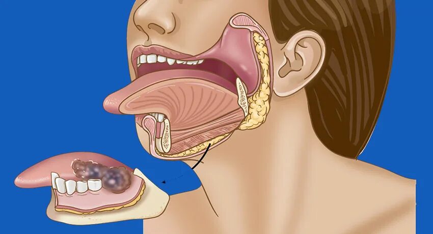 Question 1 - Oral Manifestations Question Bank - National HIV Curriculum