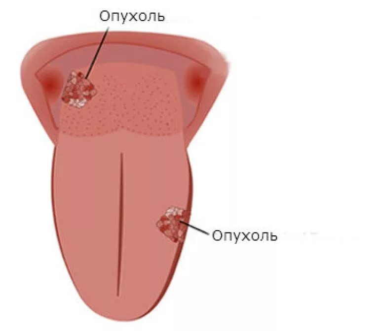 Рак языка фото начальная стадия как выглядит Little bumps on tip of tongue