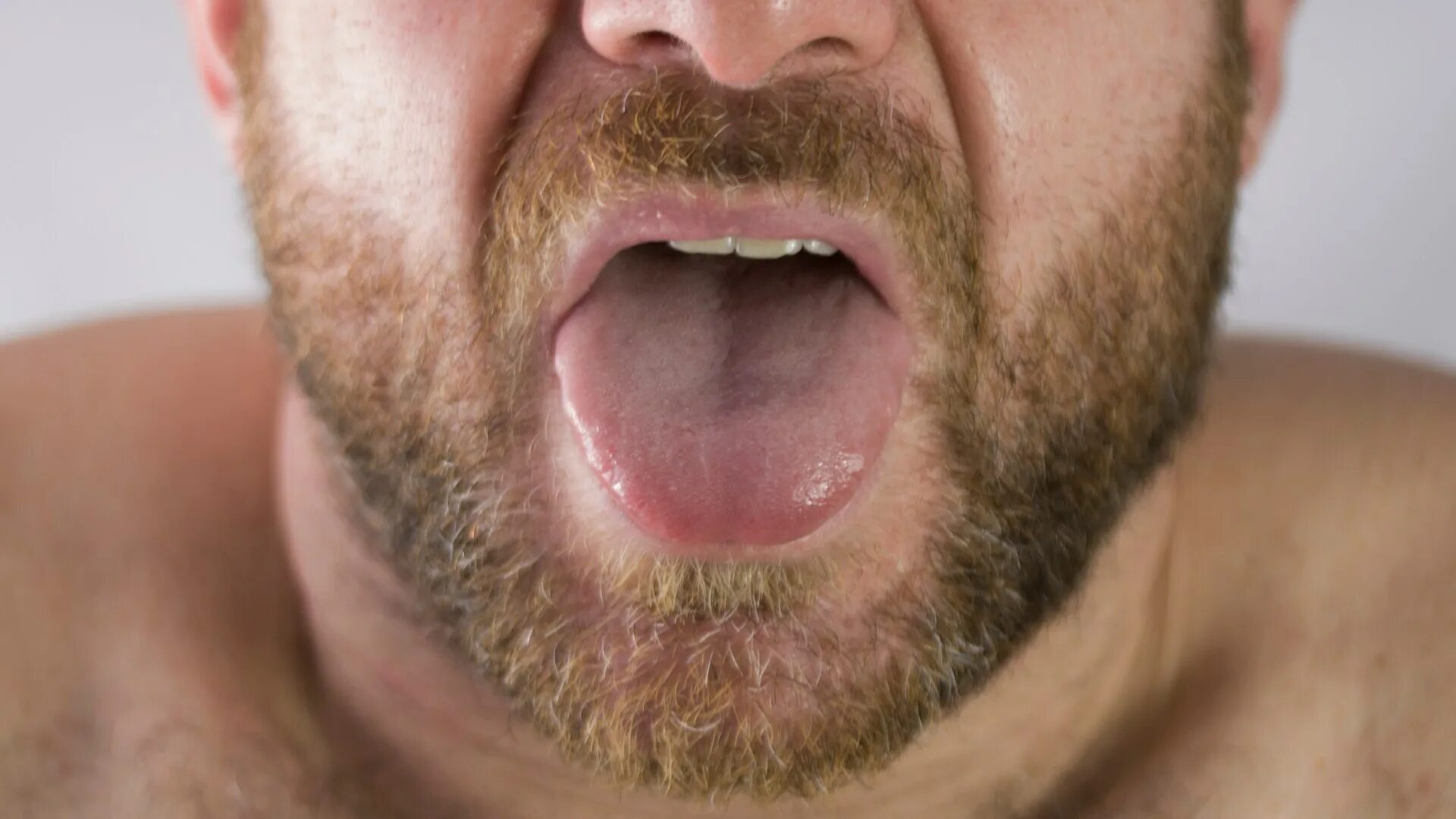 Рак языка фото последняя стадия Man's tongue mysteriously turns black and grows HAIRS after stroke The Sun