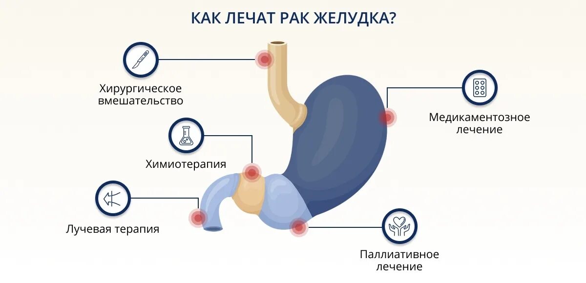 Рак желудка 4 стадии фото Рак желудка: методы и способы лечения онкологии желудка на разных стадиях