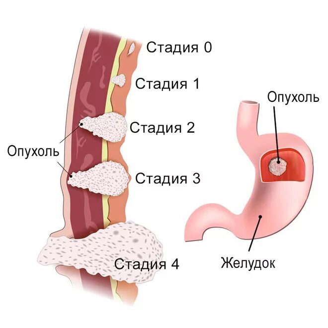 Рак желудка 4 стадии фото Полезная информация на сайте Отдела абдоминальной онкологии при ПСПБГМУ им. акад