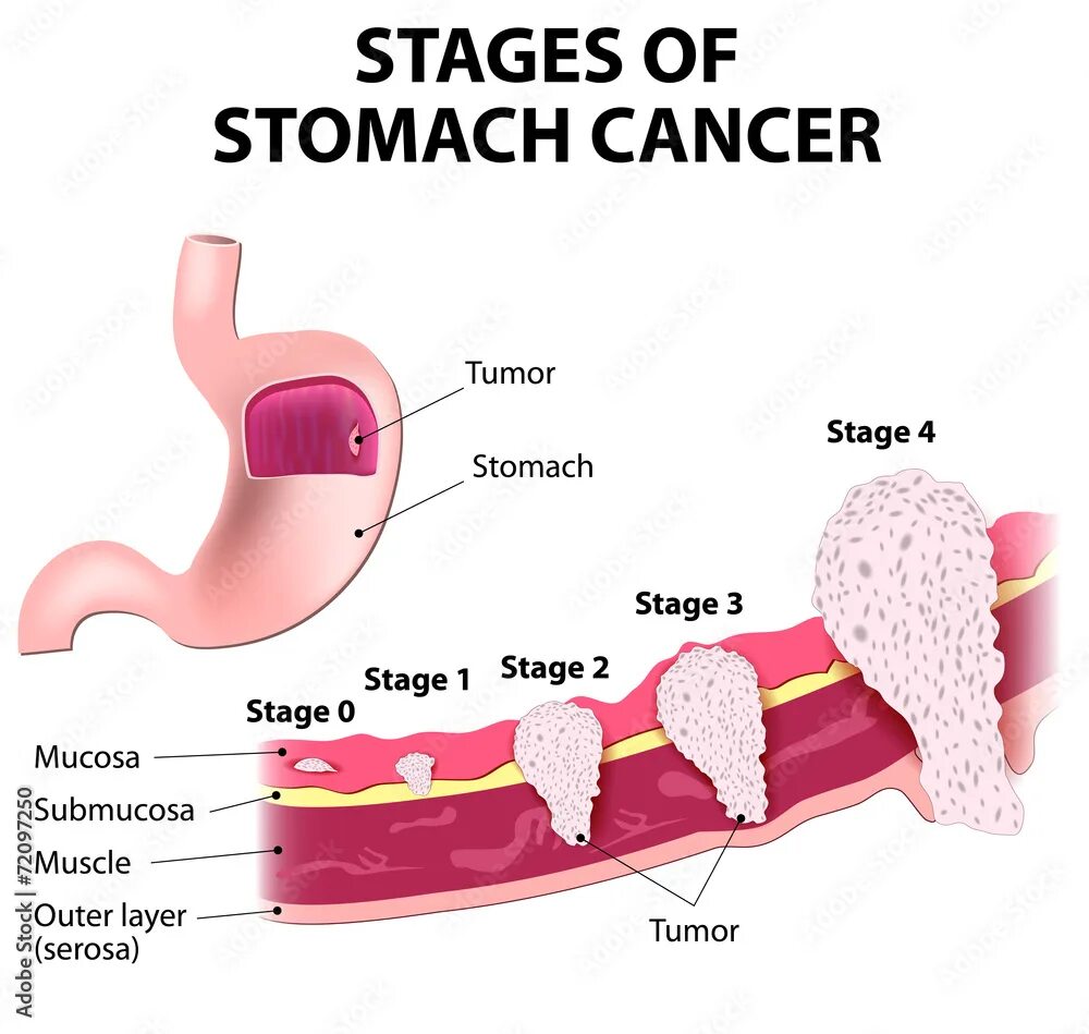 Рак желудка 4 стадии фото Staging of stomach cancer Векторный объект Stock Adobe Stock