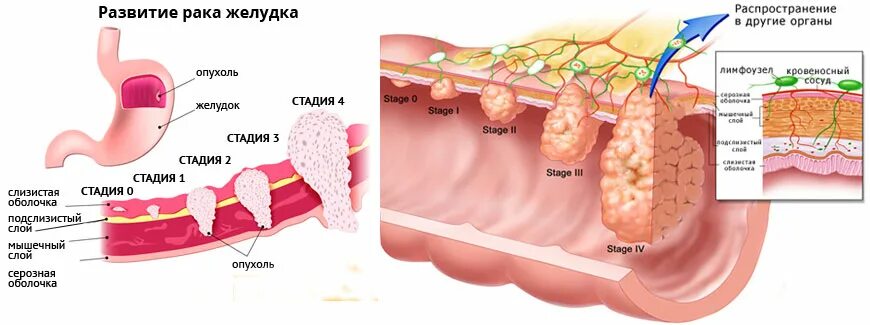 Рак желудка 4 стадии фото Ранняя диагностика рака - НИИ хирургии и неотложной медицины ПСПБГМУ им. акад. И
