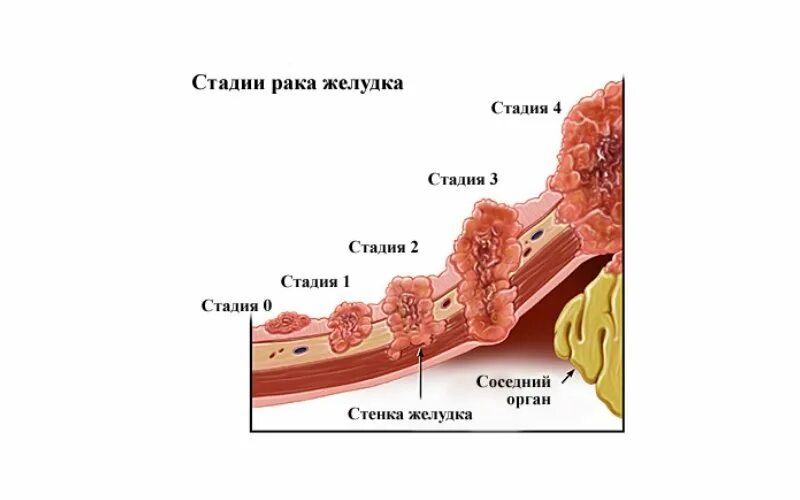 Рак желудка 4 стадии фото Стадии рака TNM классификация