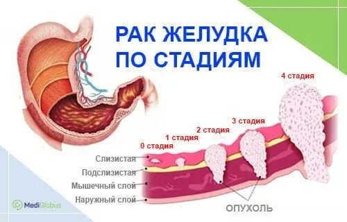 Рак желудка 4 стадии фото Лечение рака желудка лучший