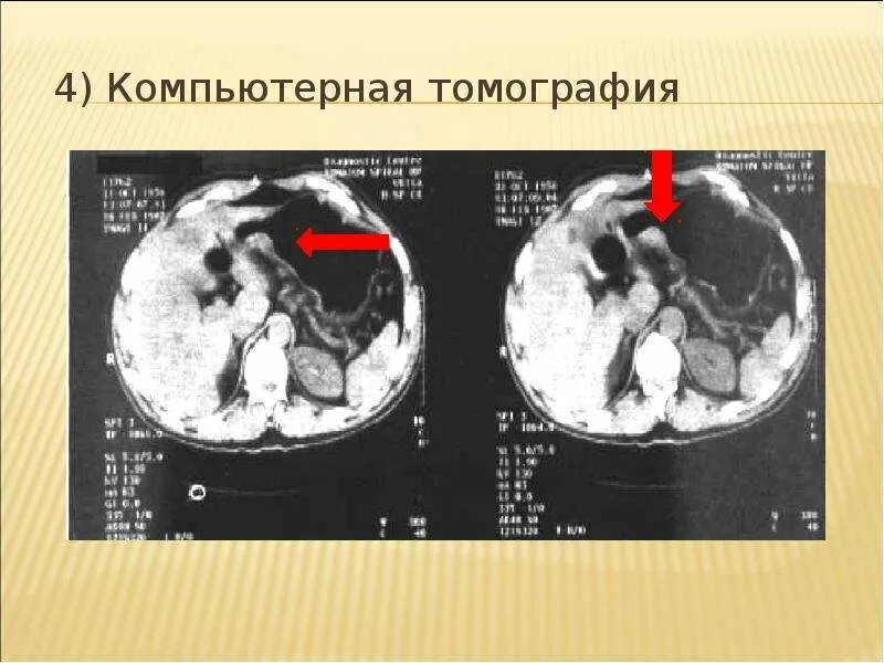 Рак желудка 4 стадии фото я рак желудка - презентация, доклад, проект скачать