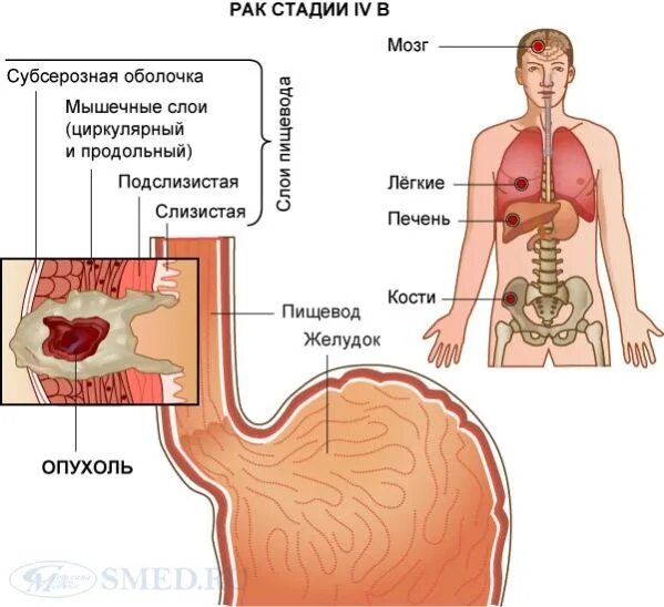 Рак желудка 4 стадии фото Рак пищевода и желудка презентация