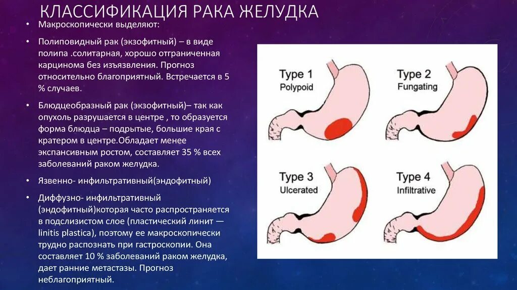 Рак желудка симптомы фото Рак желудка презентация хирургия