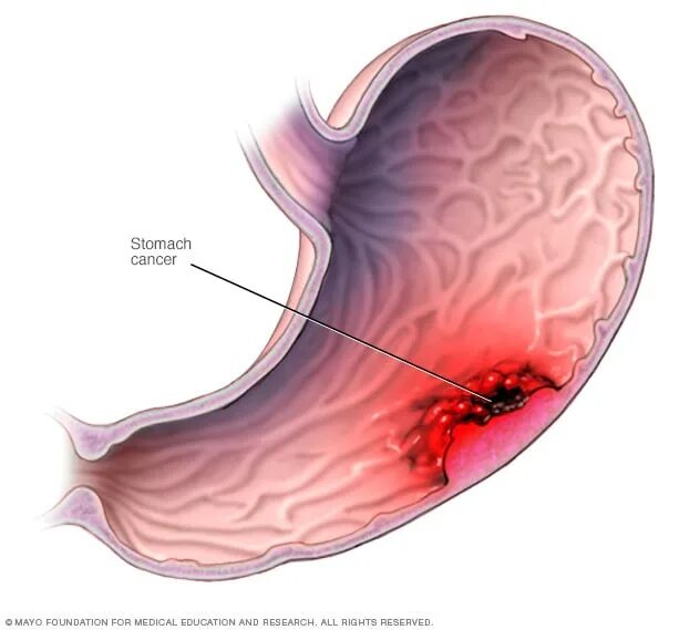 Рак желудка стадия фото Stomach cancer - Symptoms and causes - Mayo Clinic