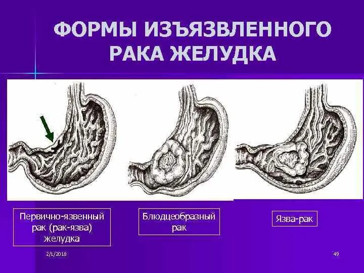 Рак желудка стадия фото Схема рак желудка