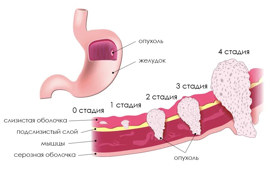 Рак желудка стадия фото Рак желудка: эффективное лечение * Русский Доктор