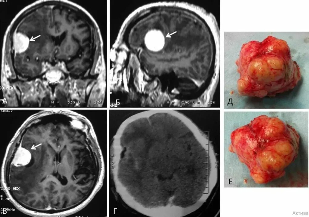 Раковая опухоль фото снаружи Терапия менингиомы