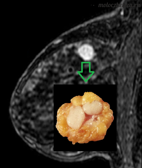 Раковая опухоль фото снаружи Признаки фиброаденоматоза молочных