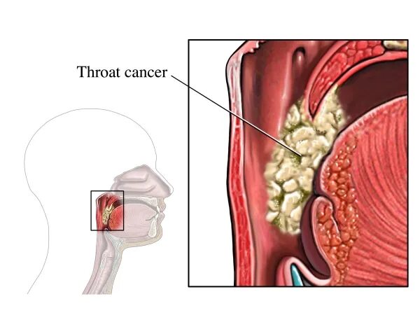 Раковая опухоль горла фото Первые признаки рака горла: симптомы, которые нельзя игнорировать