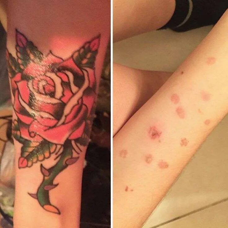 Рана от укуса фото tatuagem de rosa feita para cobrir queimaduras Tatuagem de cobra, Tatuagem de fl