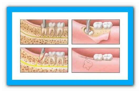 Рана после удаления зуба мудрости фото Интервью Зуба мудрости после удаления - опыт пациента и советы по реабилитации М