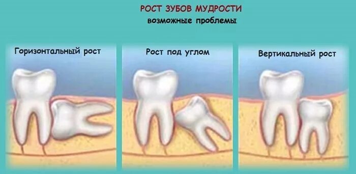 Рана после удаления зуба мудрости фото Удаление зубов мудрости - ГАУЗ СП 67 ДЗМ